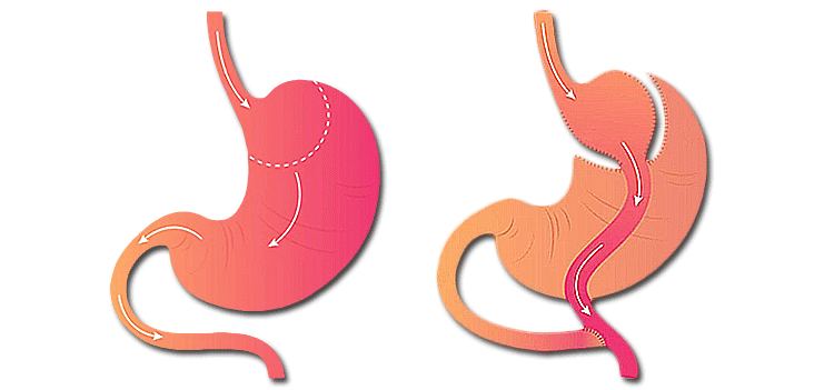 Bypass-gastrique-illustration