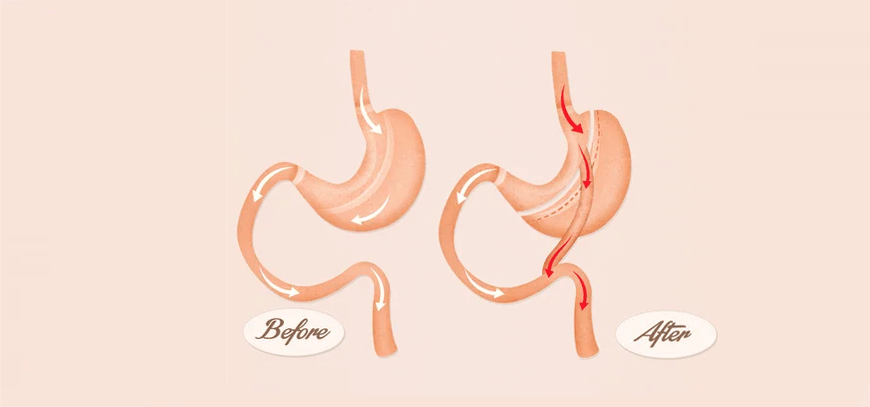 Bypass gastrique