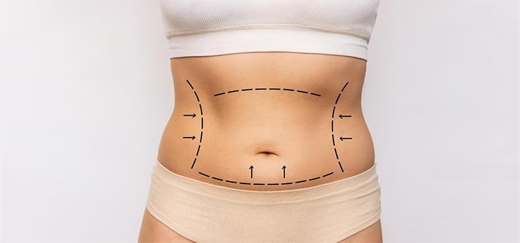 Abdominoplastie