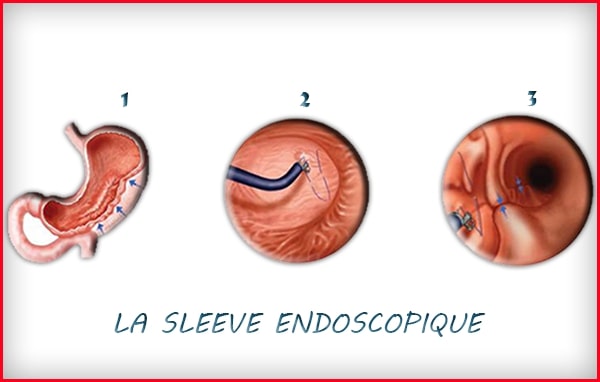 Sleeve Endoscopique 