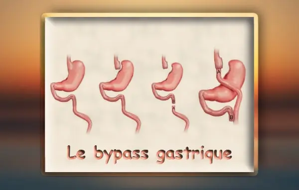 Bypass Gastrique
