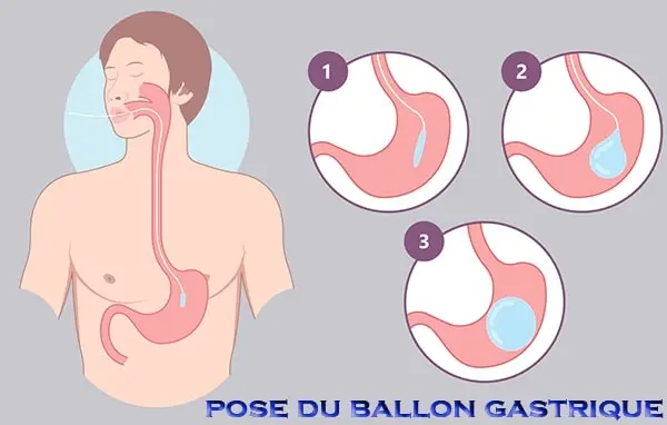 ballon gastrique