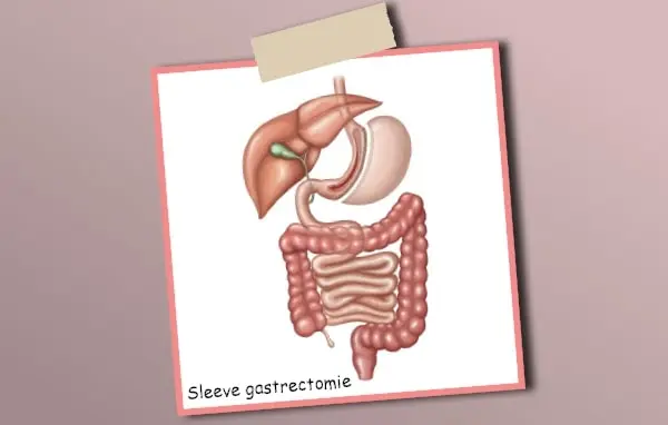 La sleeve gastrectomie