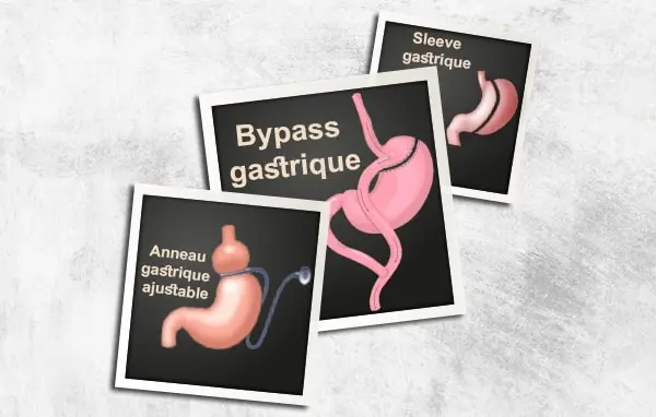 Le bypass gastrique