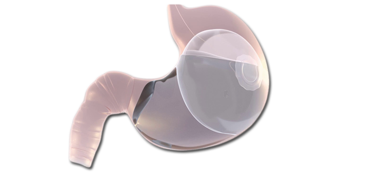 Ballon gastrique Elipse illustration