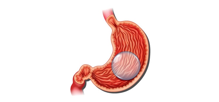 Ballon gastrique illustration